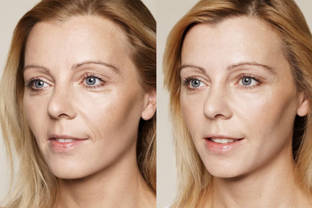 Experiencias co uso antes e despois de usar a crema intenskin de Valeria
